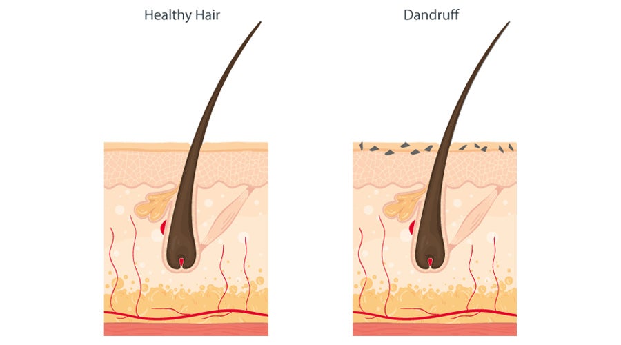 ξηροδερμία: healthy hair vs dandruff