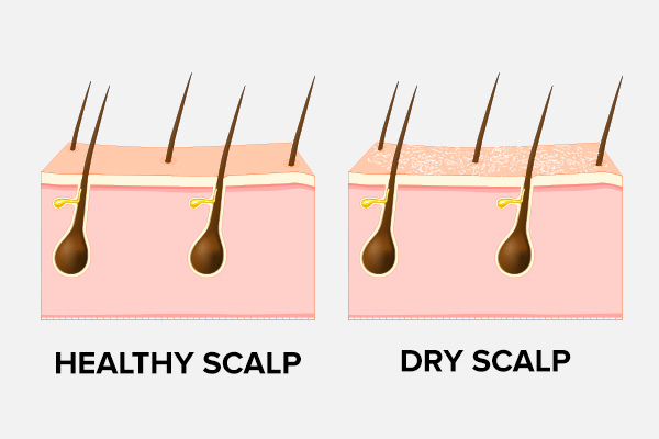 Ξηροδερμία: healthy scalp vs dry scalp